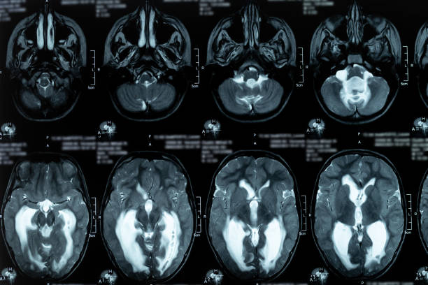 MRI scan or magnetic resonance image of the brain showed obstructive triventricular hydrocephalus. Medical service concept. Real MRI scans of the head and brain. Magnetic resonance image scan of the brain showed obstructive triventricular hydrocephalus. Background on theme of science, medicine, neurology. cerebrospinal fluid photos stock pictures, royalty-free photos & images