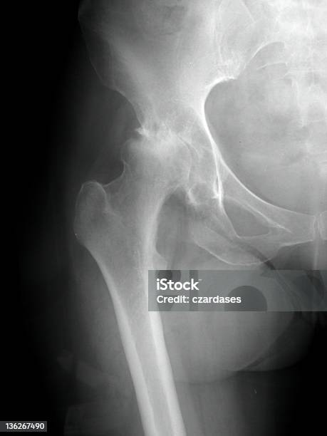 Choroba Zwyrodnieniowa Stawów - zdjęcia stockowe i więcej obrazów Endoproteza stawu biodrowego - Endoproteza stawu biodrowego, Artretyzm, Choroba zwyrodnieniowa stawów