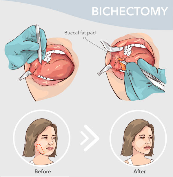 buccal fat pad entfernung vor und nach der vektorillustration - bukkal stock-grafiken, -clipart, -cartoons und -symbole