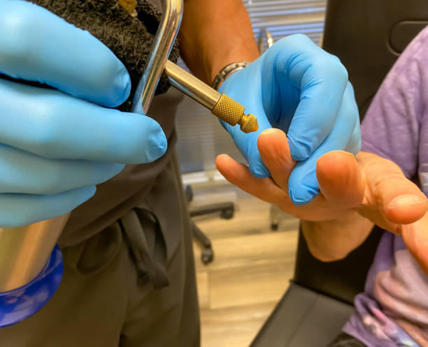 Series-Medical: Burning wart off a finger with cryotherapy. Doctor is burning a wart off a patients finger using liquid nitrogen in a process called cryosurgery squamous cell carcinoma photos stock pictures, royalty-free photos & images