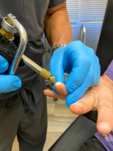 Series-Medical: Burning wart off a finger with cryotherapy. Doctor is burning a wart off a patients finger using liquid nitrogen in a process called cryosurgery squamous cell carcinoma photos stock pictures, royalty-free photos & images