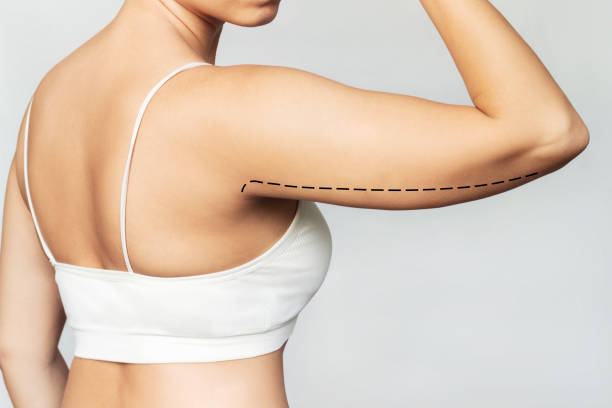 Cropped shot of a young woman with excess fat on her upper arm with marks for liposuction or surgery Cropped shot of a young woman with excess fat on her upper arm with marks for liposuction or plastic surgery isolated on a gray background. Loose and saggy muscles. Overweight. Beauty surgery concept arm stock pictures, royalty-free photos & images