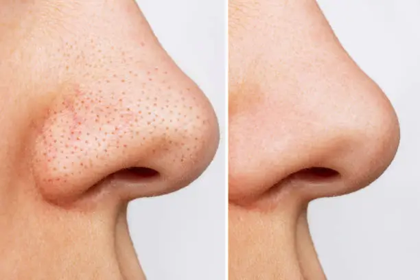 Close-up of woman's nose with blackheads or black dots before and after peeling and cleansing the face isolated on a white background. Acne problem, comedones. Difference after the cosmetic procedure