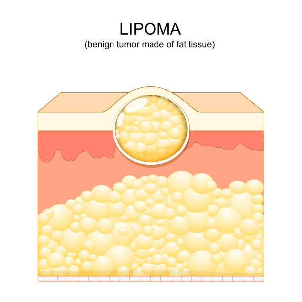 Lipoma. adipose tumors. Skin layers Lipoma. adipose tumors located into the subcutaneous tissues in the skin. Vector illustration. Skin layers surgical needle stock illustrations