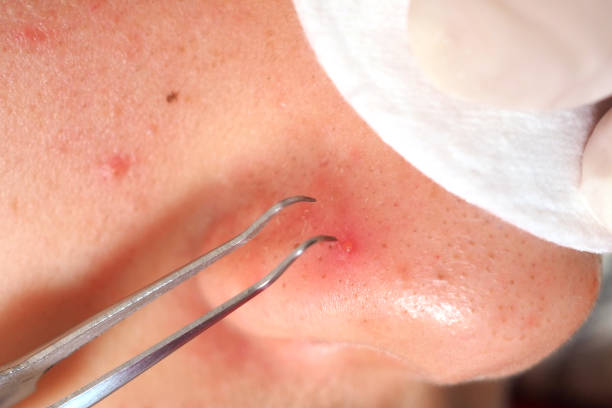 istock Removing blackheads on the nose 1363101779