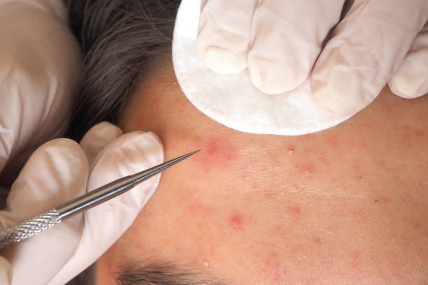 istock Cosmetic facial cleansing using a Vidal needle 1363102497