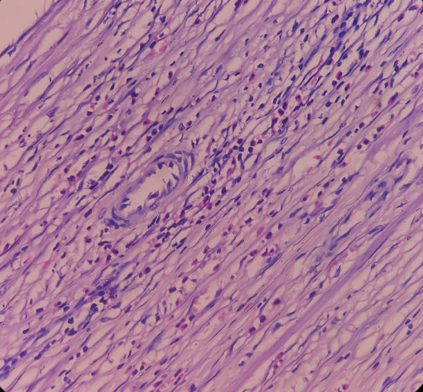 cervicite crônica, colo uterino mostram infiltração de células inflamatórias crônicas na camada sub epitelial, nenhuma célula maligna sob visão microscópica. - endometrial adenocarcinoma - fotografias e filmes do acervo