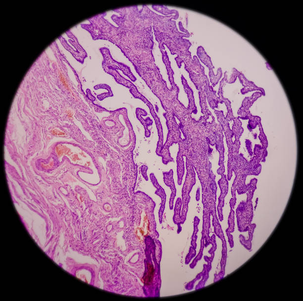 gravidez ectópica, tubo de falópio mostram villi coriônico degenerado - endometrial adenocarcinoma - fotografias e filmes do acervo