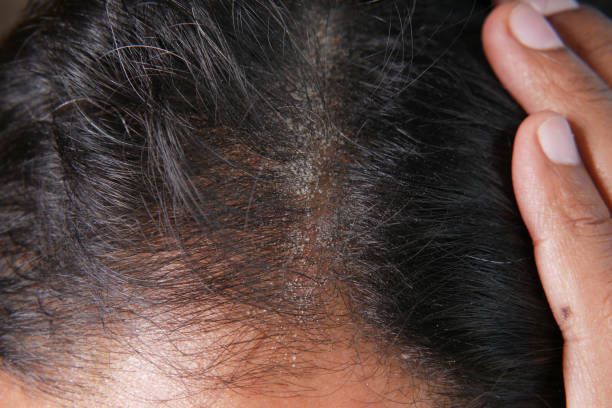 istock men with dandruff in his hair, closeup 1363298364