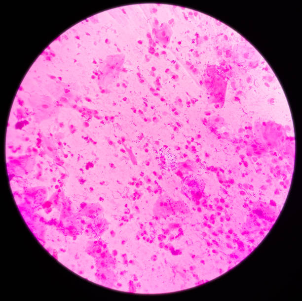 istock Sputum gram stain: Microscopic view show plenty pus cells and few epithelial cells with plenty gram positive diplococci 1363299268