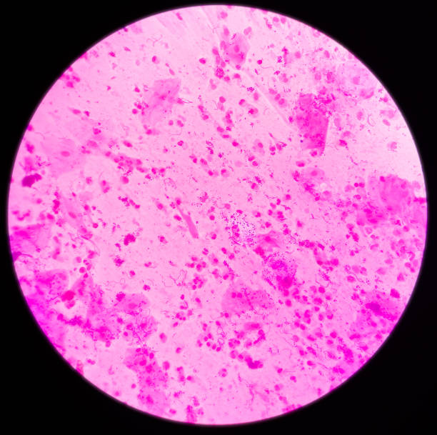 sputum gram stain: microscopic view show plenty pus cells and few epithelial cells with plenty gram positive diplococci - bacterium colony laboratory pus imagens e fotografias de stock