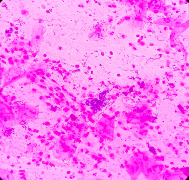 sputum gram stain: microscopic view show plenty pus cells and few epithelial cells with plenty gram positive diplococci - bacterium colony laboratory pus imagens e fotografias de stock