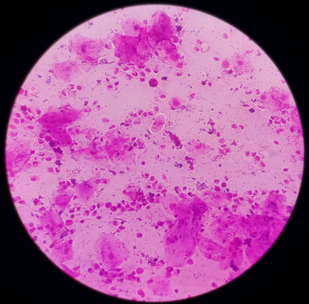 istock Sputum gram stain: Microscopic view show plenty pus cells and few epithelial cells with plenty gram positive diplococci 1363299302