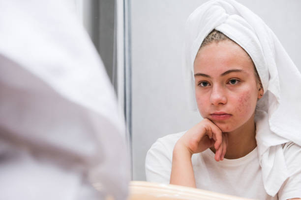 Acne. A sad teenage girl. Problematic skin in adolescents. A sad teenage girl is looking at the pimples on her face in the mirror. Problematic skin in adolescents. Acne. mirror lake stock pictures, royalty-free photos & images