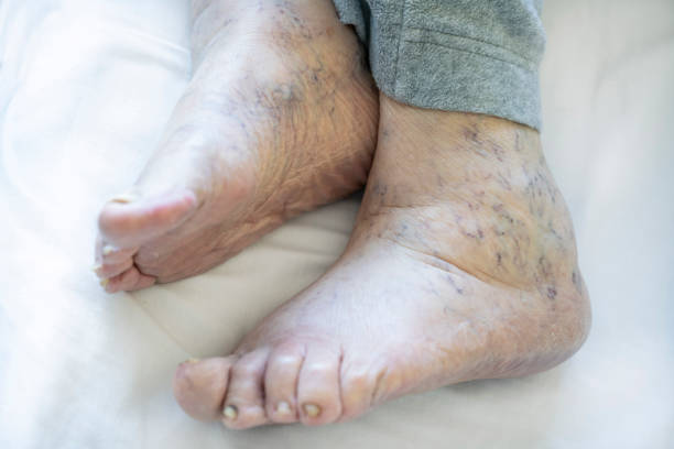 closeup feet of an old person with edema, varicose veins and toenail fungus feet, closeup feet of an old senior woman or man with edema, varicose veins and toenail fungus. unhealthy foot with selective focus and noise effects. health care concept photo ugly old women stock pictures, royalty-free photos & images