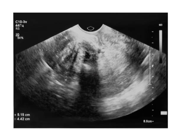 istock Ultrasound image of myoma 1363594438