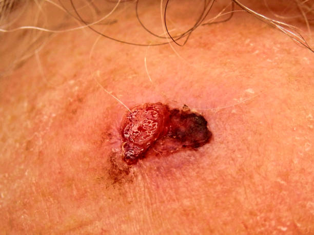 carcinome épidermoïde de la peau - carcinogens photos et images de collection