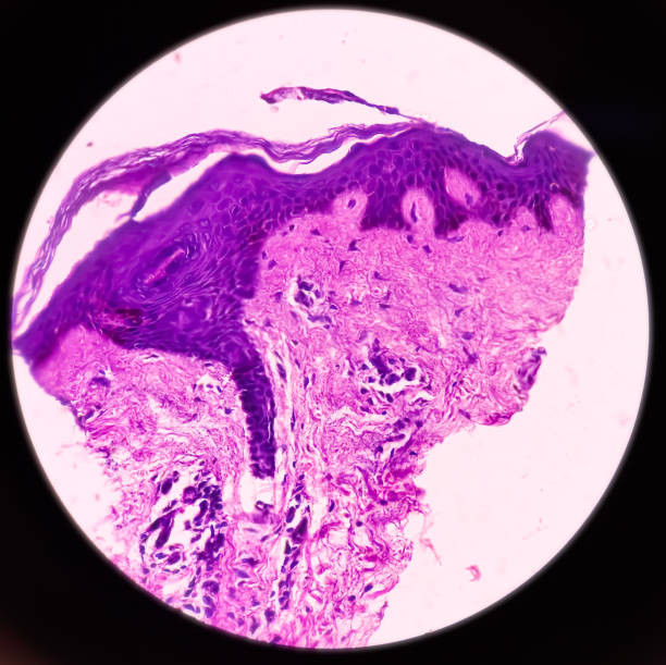 istock Chest wall cyst(biopsy): Epidermal inclusion cyst, commonly called 