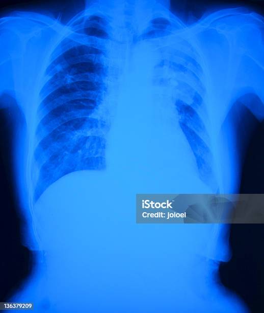 胸 X 線フィルム - X線撮影のストックフォトや画像を多数ご用意 - X線撮影, データ, ヒトの内臓