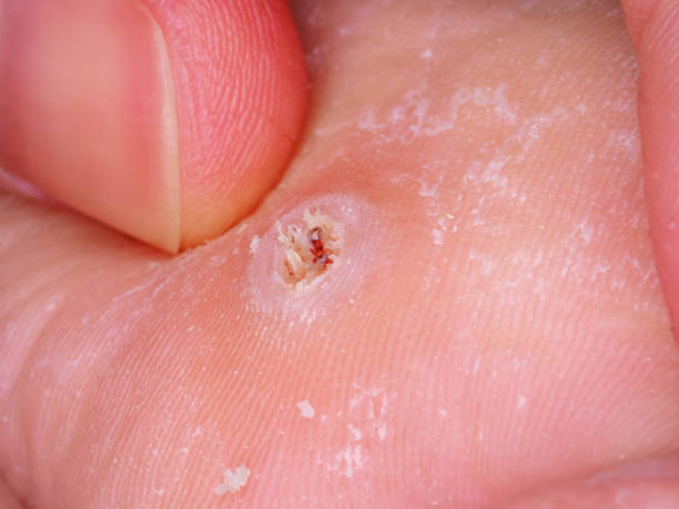 istock callus growth on the foot 1363901183