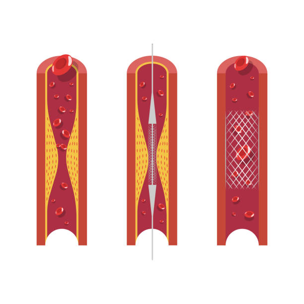 흰색 배경에 차단 된 동맥을 여는 데 사용되는 스텐트 - angioplasty stock illustrations