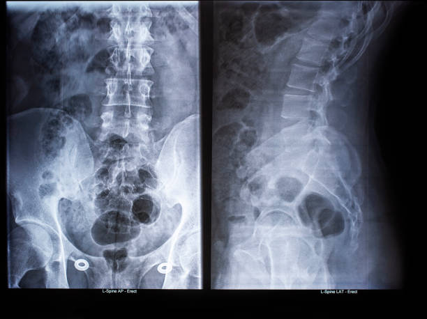 magnetresonanztomographie oder mrt-bericht von rückenmark oder lendenwirbelvorwölbung oder lendenwirbel - lumbar vertebra stock-fotos und bilder