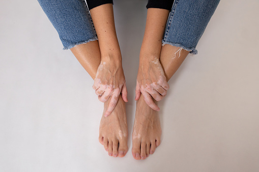 Hands and feet with vitiligo on white background