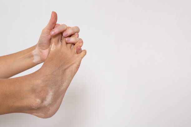 istock Hands and feet with vitiligo 1364084270