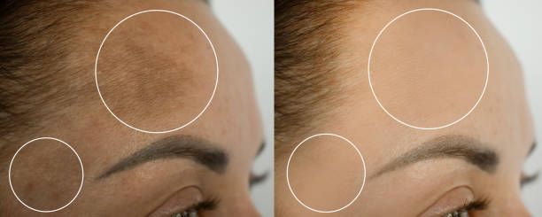 woman forehead pigmentation before and after treatment woman forehead pigmentation before and after treatment botox before and after stock pictures, royalty-free photos & images