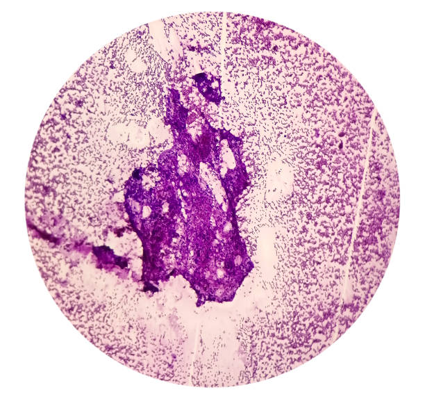 Photomicrograph of fine needle aspiration (FNA) cytology of a pulmonary (lung) nodule showing adenocarcinoma, a type of non small cell carcinoma. 10x Photomicrograph of fine needle aspiration (FNA) cytology of a pulmonary (lung) nodule showing adenocarcinoma, a type of non small cell carcinoma. 10x squamous cell carcinoma photos stock pictures, royalty-free photos & images