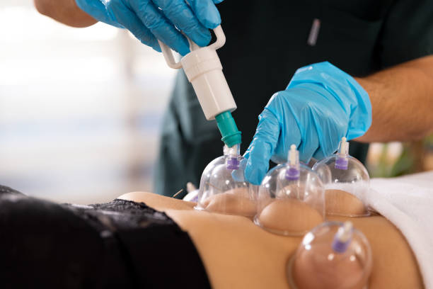 istock A doctor practices acupuncture therapy and vacuum cupping. 1364149604