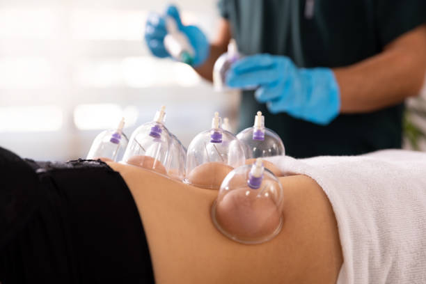 A doctor practices acupuncture therapy and vacuum cupping. Acupuncturist doctor inserts an acupuncture needle into and vacuum cupping a woman's abdominal. She treats by restoring the flow of energy from certain points in the body. cupping therapy stock pictures, royalty-free photos & images