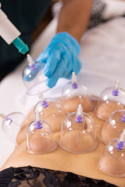 istock A doctor practices acupuncture therapy and vacuum cupping. 1364149710