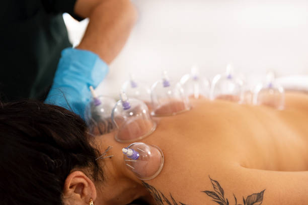 istock A doctor practices acupuncture therapy and vacuum cupping. 1364151302