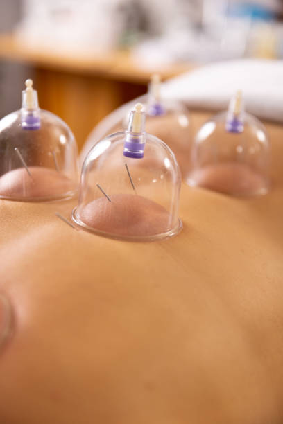 ein arzt praktiziert akupunkturtherapie und vakuumschröpfen. - acupuncture cupping stock-fotos und bilder