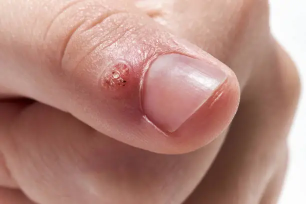 Viral wart (verruca) on the finger close up on white background. Skin disease  caused by a type of human papillomavirus HPV.