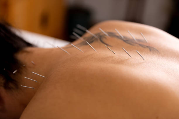 istock A doctor practices acupuncture therapy. 1364151760