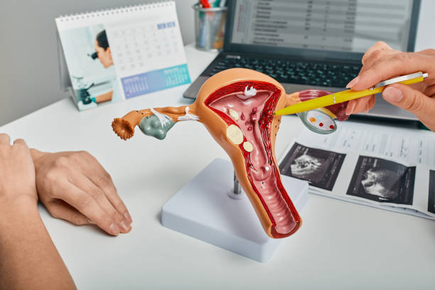 istock Gynecologist showing polyps of endometrium of uterus using anatomical model during consultation to female patient. Gynecology, treatment of uterine polyps 1364163174