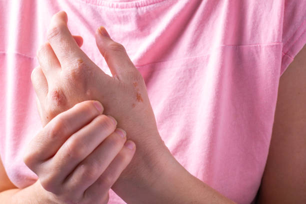 istock Close-up of a woman's hands itching. dermatitis or eczema on the hands. 1364176341