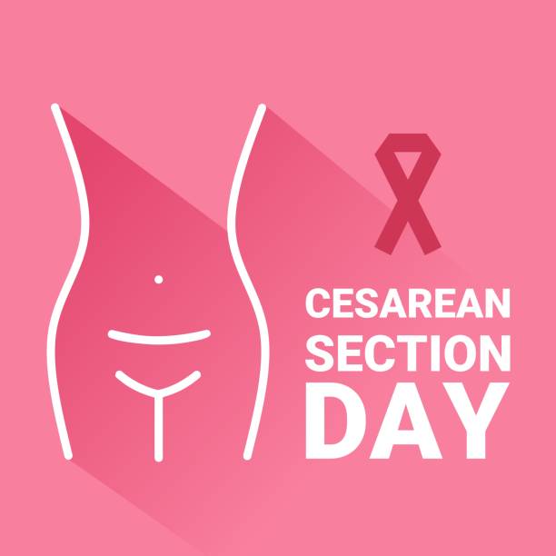 ilustrações, clipart, desenhos animados e ícones de ilustração vetorial, barriga de mulher com ferida de cesariana, como banner ou cartaz, dia da cesariana. - cesarean