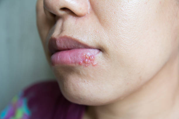 istock Close up a virus herpes on lips women 1364338571