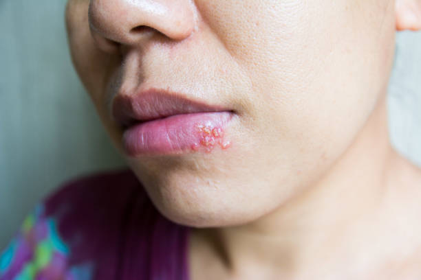 istock Close up a virus herpes on lips women 1364338621