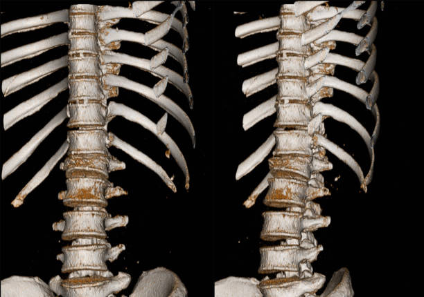 tomografía computarizada médica y radiografía de la columna torácica. - cat scan abdomen medical scan x ray fotografías e imágenes de stock