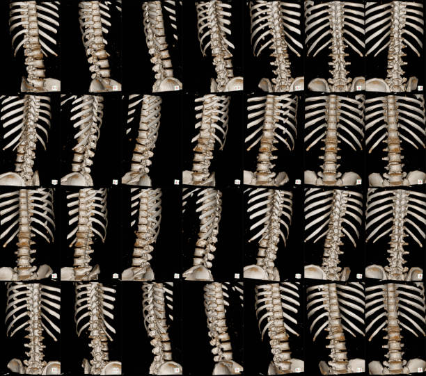 tomografía computarizada médica y radiografía de la columna torácica. - cat scan abdomen medical scan x ray fotografías e imágenes de stock