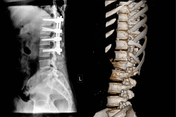 tomografía computarizada médica y radiografía de la columna torácica. - cat scan abdomen medical scan x ray fotografías e imágenes de stock
