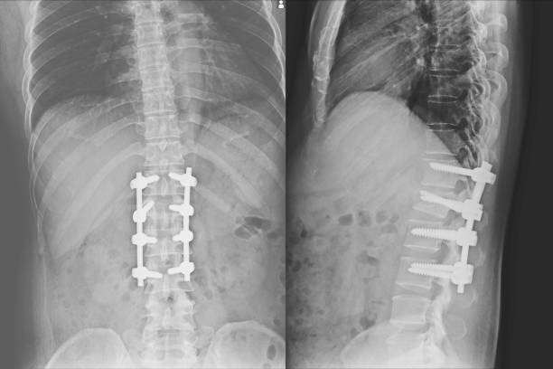 tomografía computarizada médica y radiografía de la columna torácica. - cat scan abdomen medical scan x ray fotografías e imágenes de stock