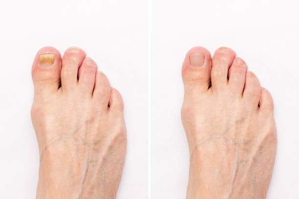 primo piano di un piede maschio con brutto fungo giallo sulle unghie dei piedi e unghie sane prima dopo il trattamento - toenail foto e immagini stock