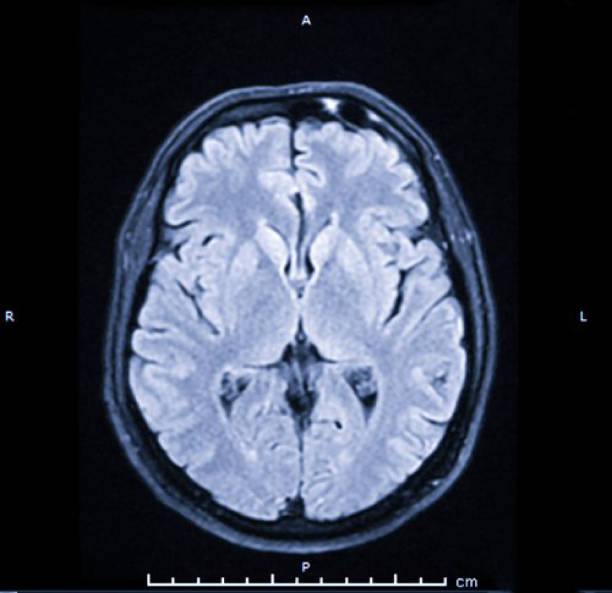 brain mri scan. scanning of brain's magnetic resonance image. diagnostic medical tool - brain scan' bildbanksfoton och bilder