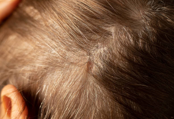 Dry itchy scalp with scabs on woman's head with hair. Dandruff seborrhea problem on skin. A closeup.