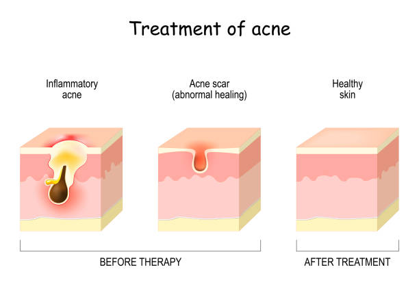 Treatment of acne. Skin layers Before and after therapy. Treatment of acne. Skin layers Before and after therapy. Inflammatory acne, scar or abnormal healing and healthy skin. vector illustration acne before and after stock illustrations
